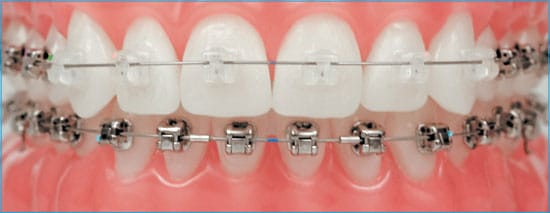 Dental model wearing Damon braces with sliding-door clips instead of elastic ties