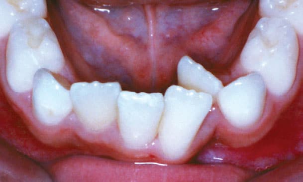 Crowded lower front teeth overlapping each other from lack of space