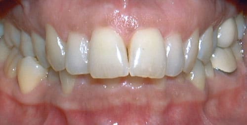 Adult smile with a deep overbite, the upper teeth covering most of the lower teeth