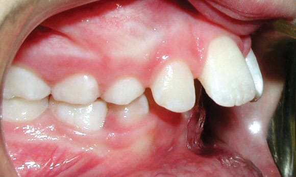 Upper front teeth protruding well past the lower teeth